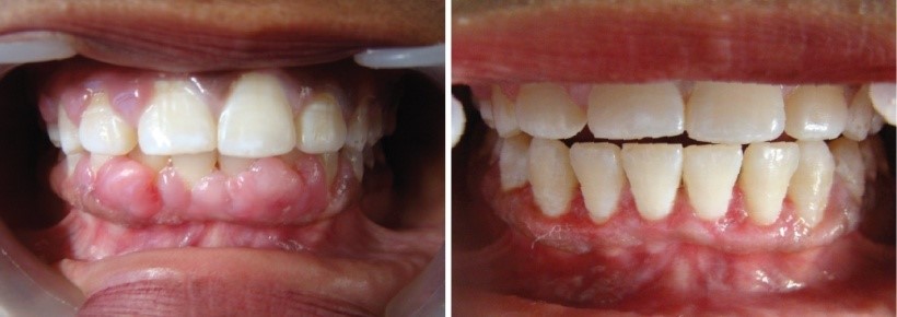 Gingivectony & Gingivoplasty services