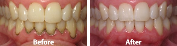 best Teeth Scaling and polishing services