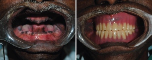 best Dental prosthesis