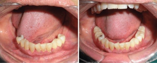 best Dental prosthesis services in bhopal