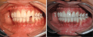 Dental Bridges services