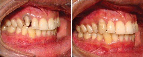 Dental crowns services