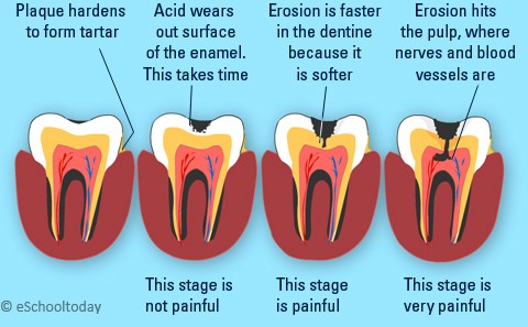Root Canal Treatment services